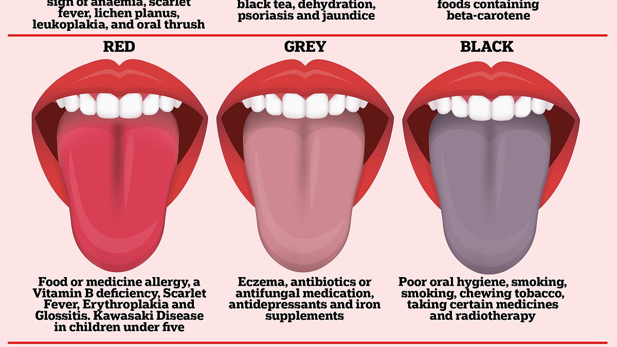 Après que le viral TikTok ait affirmé que les « fissures » sur la langue signifiaient que vous ne devriez pas boire de café, nous révélons les problèmes médicaux que vous pouvez voir en regardant dans la bouche