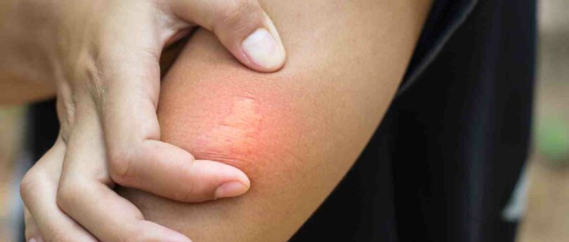 8 Effective Home Remedies For Bee Stings